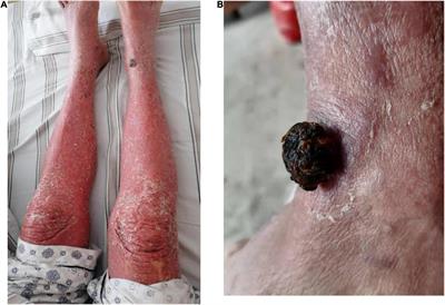 Case Report: Successful Treatment of Kaposi’s Sarcoma With Anlotinib in an HIV-Negative Patient After the Treatment of Drug Reaction With Eosinophilia and Systemic Symptoms Accessory Tragus